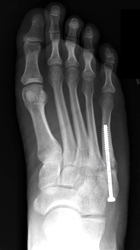 Types Of 5th Metatarsal Fractures
