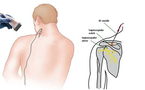 Suprascapular Nerve Rf Ablation For Chronic Shoulder Pain