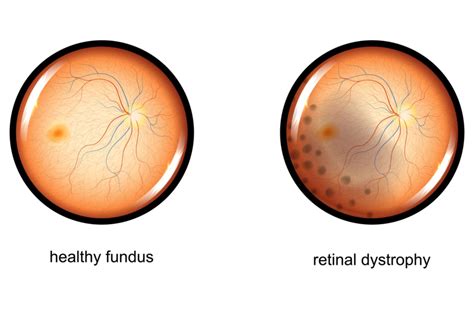 Retinal Dystrophies Causes Symptoms And Treatments