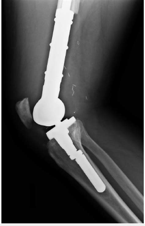 Lateral Right Knee Radiography Knee Replacement With Prosthetic