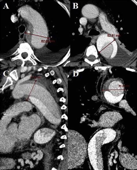 Thoracic Endovascular Aortic Repair For Type B Acute Aortic Dissection