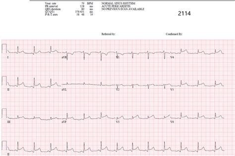 Dr Smiths Ecg Blog You Diagnose Pericarditis At Your Peril At The
