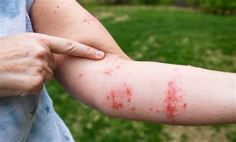 Poison Ivy A Miserable Rash Dr G Opines