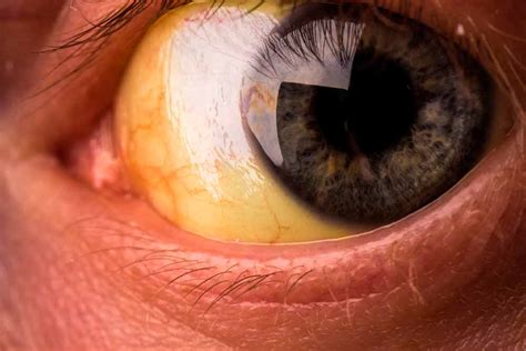 Gele ogen oorzaken en behandeling Área Oftalmológica Avanzada