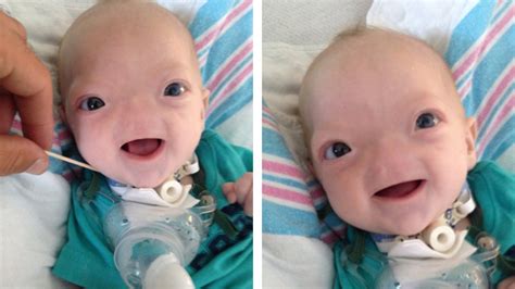 Baby Born Without A Nose Is So Cute Hes Melting Peoples Hearts All