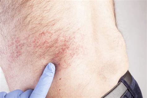 What Is Shingles Facty Health