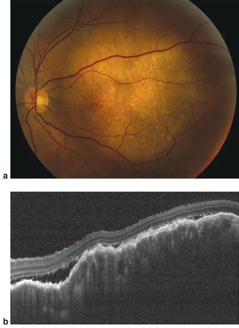 Optical Coherence Tomography Oct American Academy Of Ophthalmology