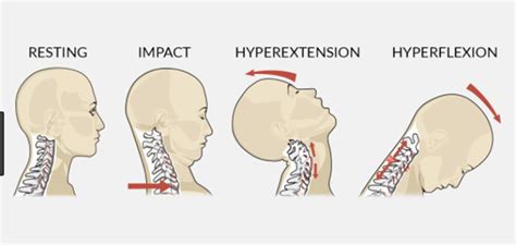 Symptoms Of Whiplash From Rear End Collision Verdell Paulson