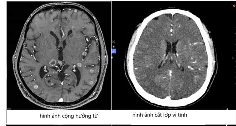 GIÁ TRỊ CỦA CHỤP CỘNG HƯỞNG TỪ MRI SỌ NÃO TRONG CHẨN ĐOÁN UNG THƯ DI