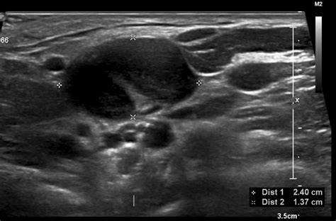 Jugulodigastric Lymph Node Normal Ultrasound Image