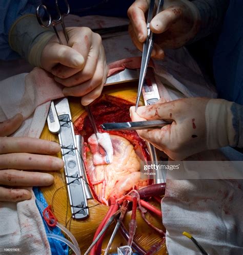 Heart Surgery Cabg Stock Photo Getty Images