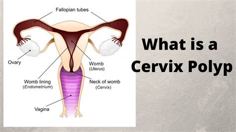 What Is A Cervix Polyp Youtube