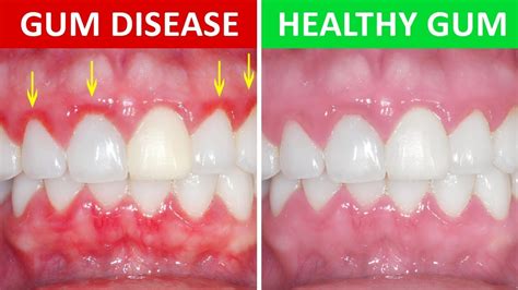 Gum Inflammation Gingivitis Symptoms And Remedies