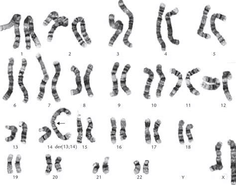Trisomy 13 Karyotype