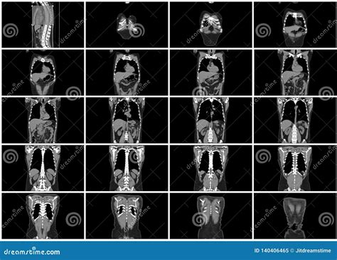 Ct Scan Step Set Of Body Coronal View Stock Image Image Of Digital