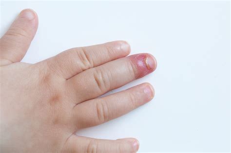 Types Of Fingernail Infections Design Talk