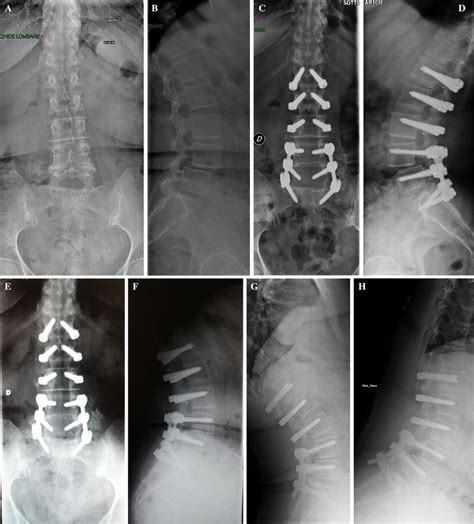 A B Case 15 Female 60 Years Old De Novo Mild Lumbar Scoliosis And