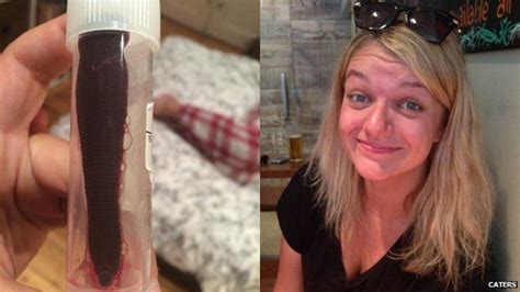 Woman Finds Three Inch Leech In Nose After South East Asia Trip Bbc News