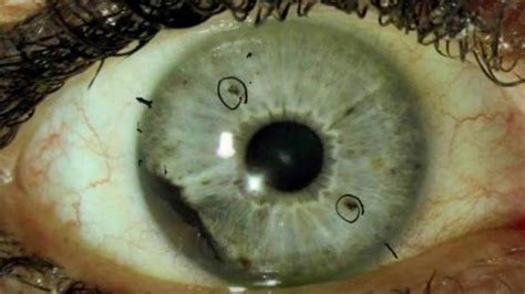 Dozens Develop Rare Eye Cancer In A Case Thats Baffling Doctors Fox News