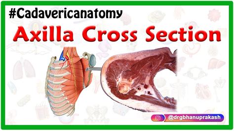 Anatomy Of Axilla Cross Section Cadaveric Anatomy Boundaries And