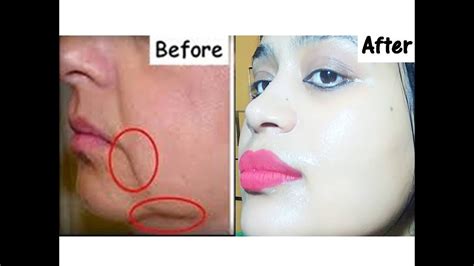 Live Demohow To Lift The Corners Of Your Mouth Just 3 Days Remove