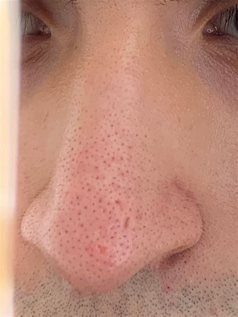 Misc What To Do About These Nose Scars Idk What To Use To Maybe Minimize Them Or What