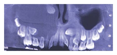 Bilateral Maxillary Dentigerous Cysts In A Nonsyndromic Child A Rare