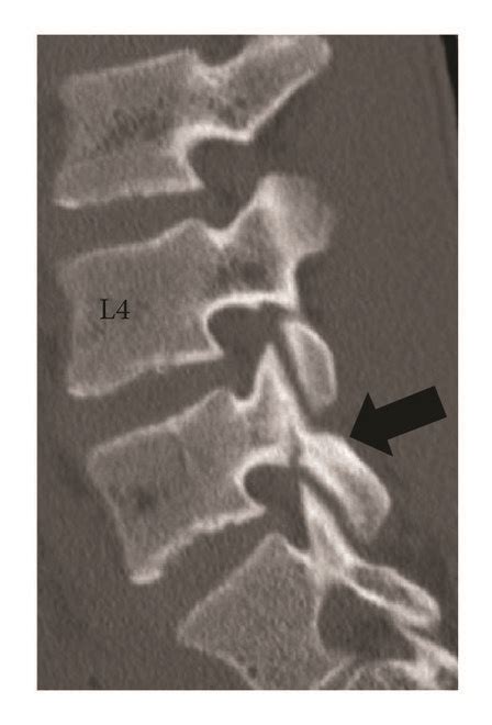 Reconstructed Computed Tomography Ct Scan Of The Lumbar Spine From