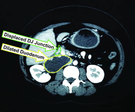 Transverse View Of Ct Scan Abdomen Showing Dilated Duodenum And