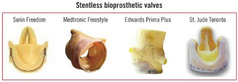 Stentless Bioprosthetic Valves Download Scientific Diagram