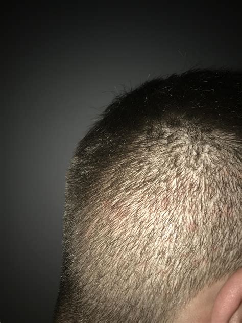 Red Spots All Over Scalp My Scalp Always Goes Through Stages Where It