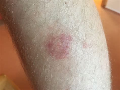 Ein zeckenbiss verläuft in vielen fällen harmlos. Roter Kreis am Bein. Zeckenstich? (Borreliose ...