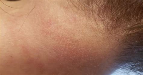 What Does This Rash On Back Of Neck Mean