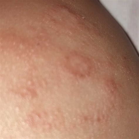 Asktheexpert Hi My Baby Is 1 Year Old He Has Some Skin Rashes On The