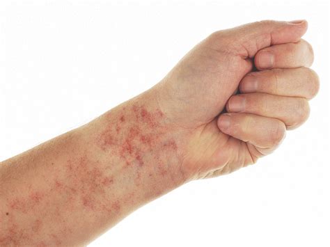 Petechiae Causes Treatments Pictures And More