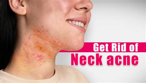 How To Get Rid Of Neck Acne Health For Best Life