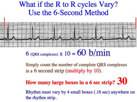 Triplets R To R And 6 Second Heart Rate Method