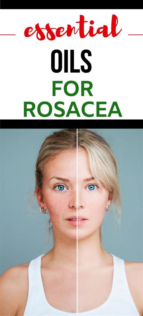 Essential Oils For Rosacea Essential Oils For Rosacea Natural