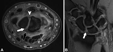 Preoperative And Postoperative Imaging Of Scapholunate Ligament Primary Repair And Modified