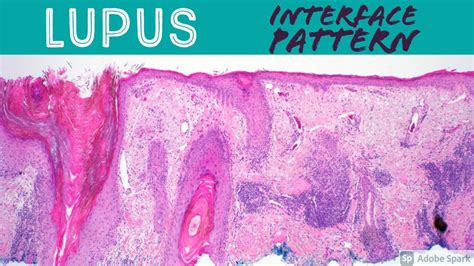Lupus Erythematosus Interface Dermatitis Inflammatory Dermpath