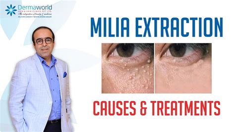 Milia Extraction Causes And Treatment Milia Under The Eyes Dr Rohit
