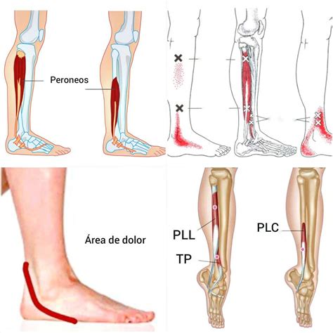 Ejercicios Y Tratamiento Para La Tendinitis De Los Peroneos Tendinitis