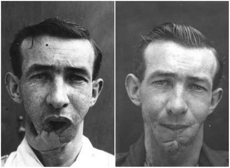 Faces From The Front Incredible Before And After Photos Show World War I Soldiers Horrific