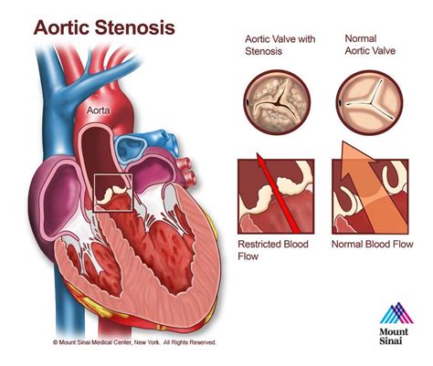 Aortic Stenosis The Mount Sinai Hospital Aortic Stenosis Stenosis Cardiology