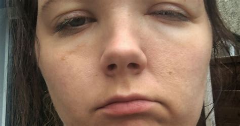 Mum Left With Swollen And Burnt Face After Allergic Reaction To Box