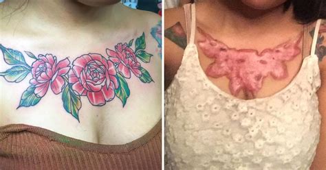 Tattoo Removal Scars After Pasuda Reaws Surgery Went Horribly Wrong