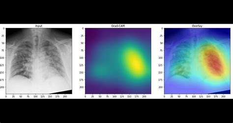 Ai Detects Covid 19 On Chest X Rays With Accuracy And Speed News