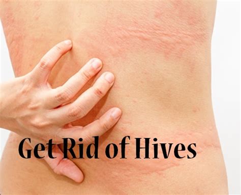 How To Get Rid Of Hives