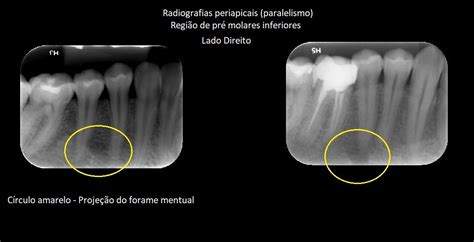 Anatomia Radiográfica E Tomográfica Aplicada à Odontologia Parte Ii