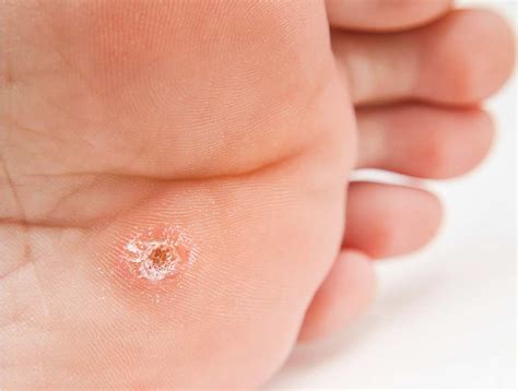 Radiofrequency Removal Of Plantar Warts Bone Clinic And Neurosurgeon
